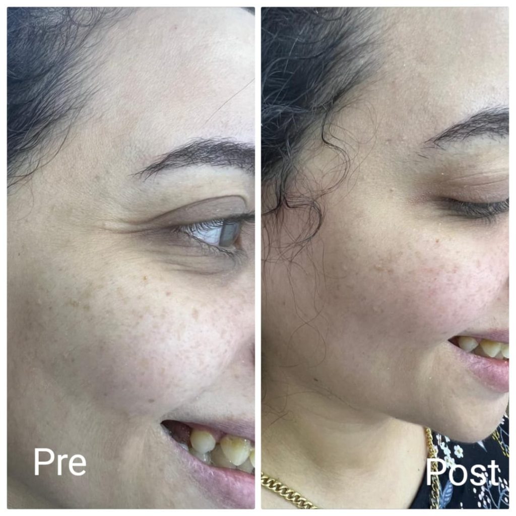Results of Botox injections with a plastic surgeon in Hurghada