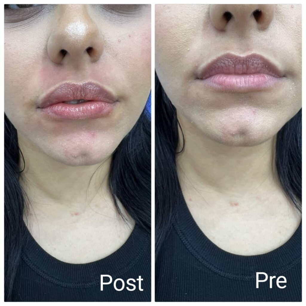Results of lip plumping with filler before and after