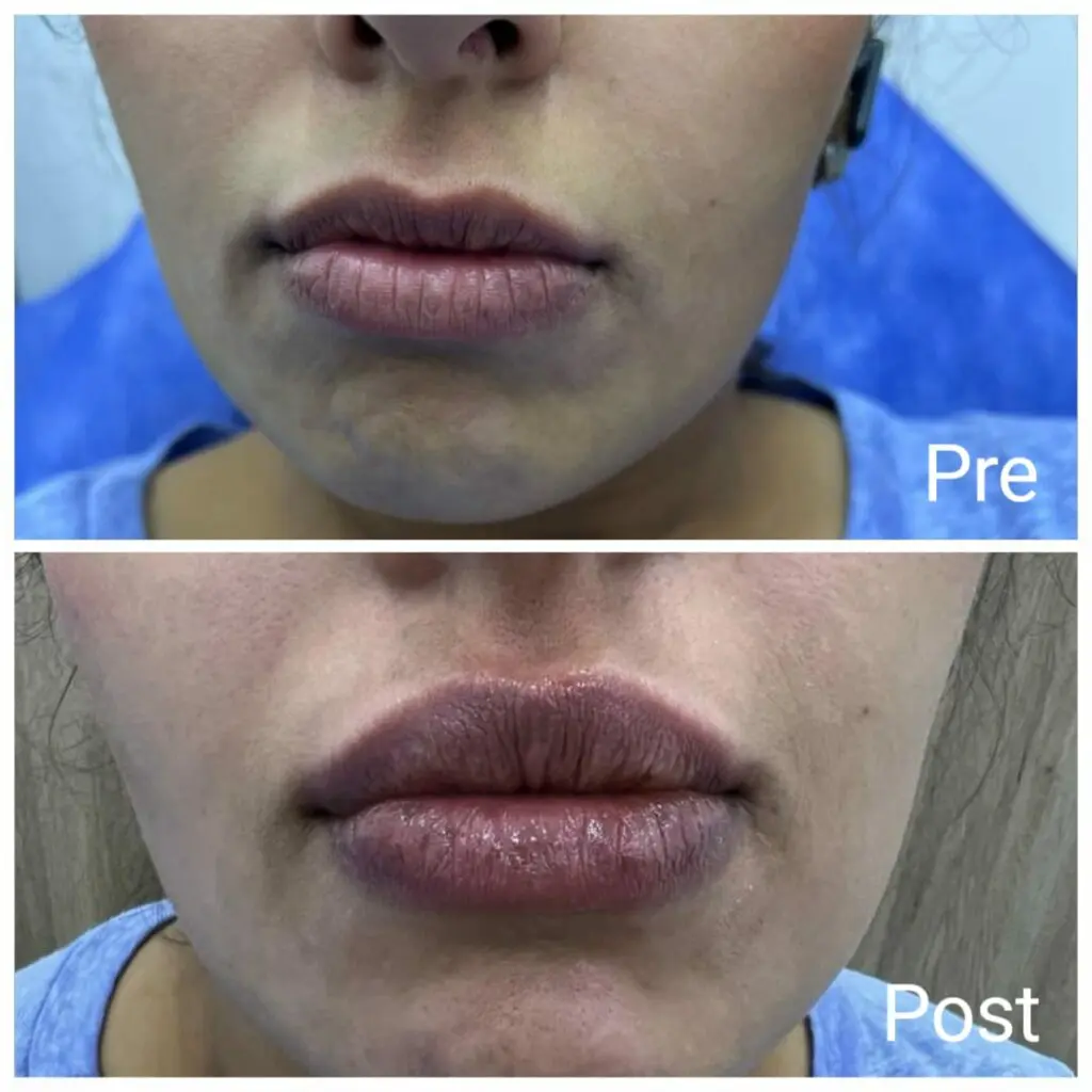 Results of lip filler injections before and after