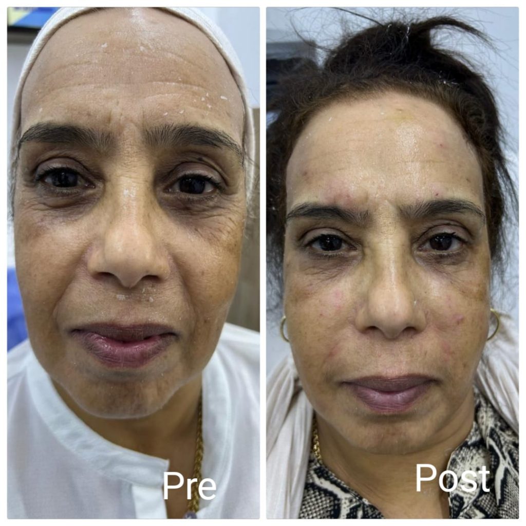 Facial plastic surgery, removing the smile line and sculpting the eyes