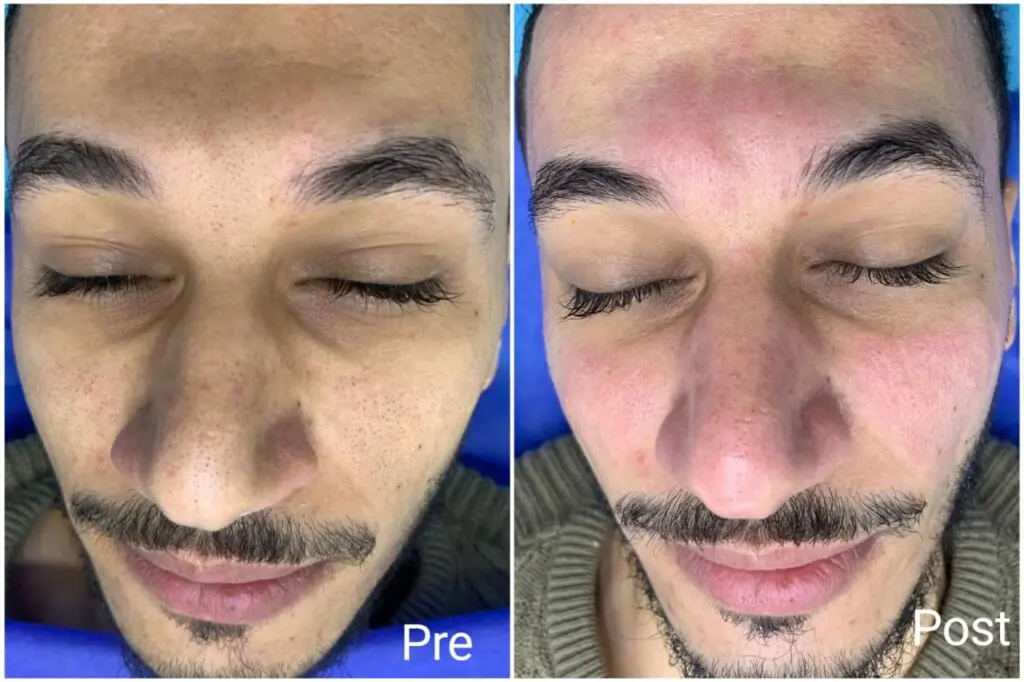 Netwage skin session before and after