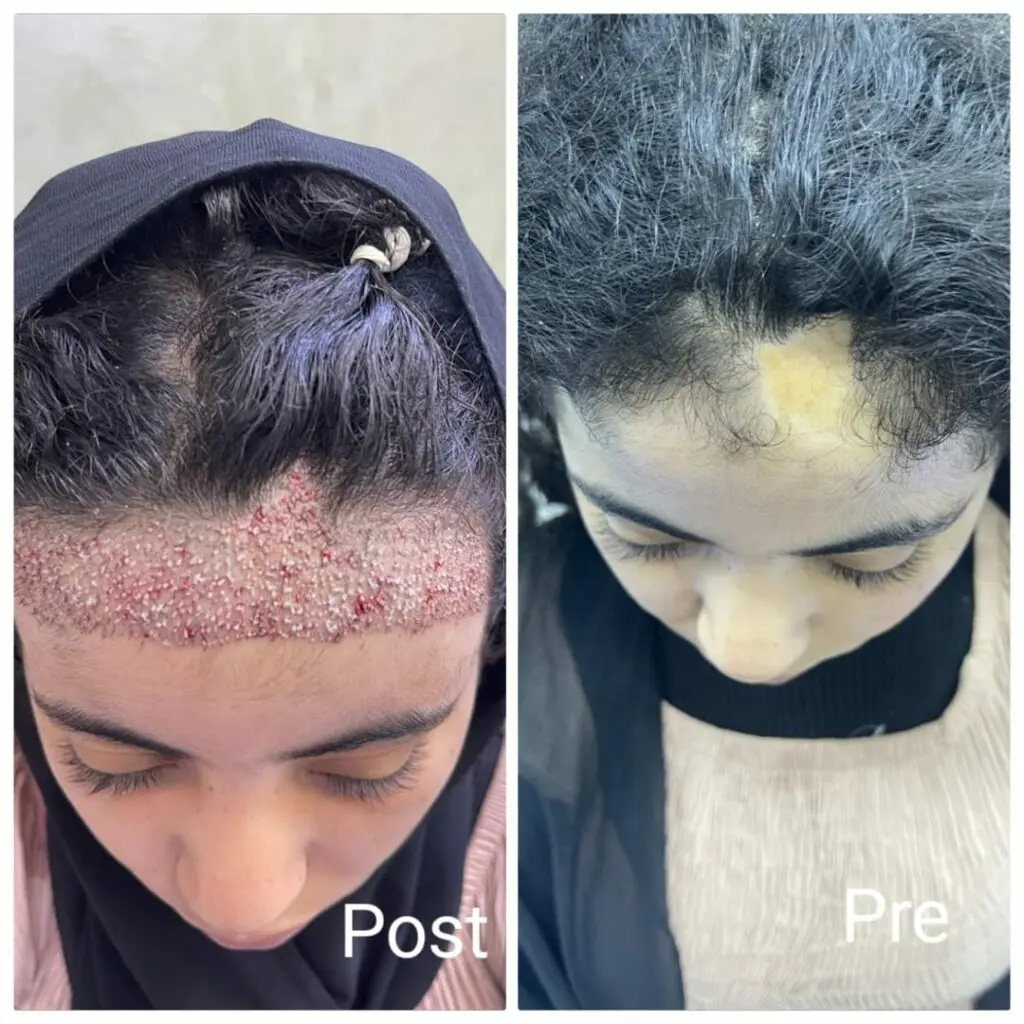 Hair transplantation by extraction in Hurghada, Egypt