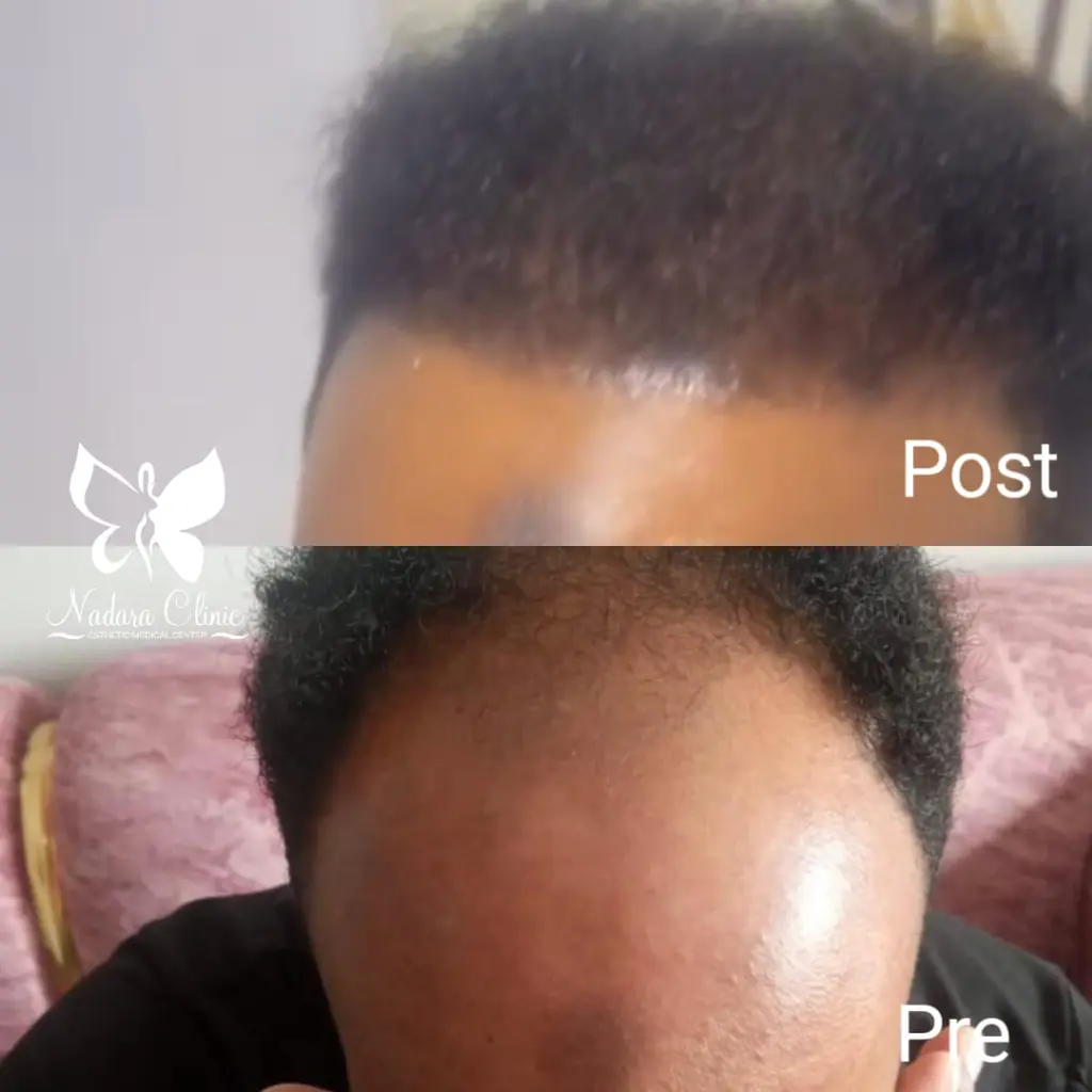 Hair transplant before and after