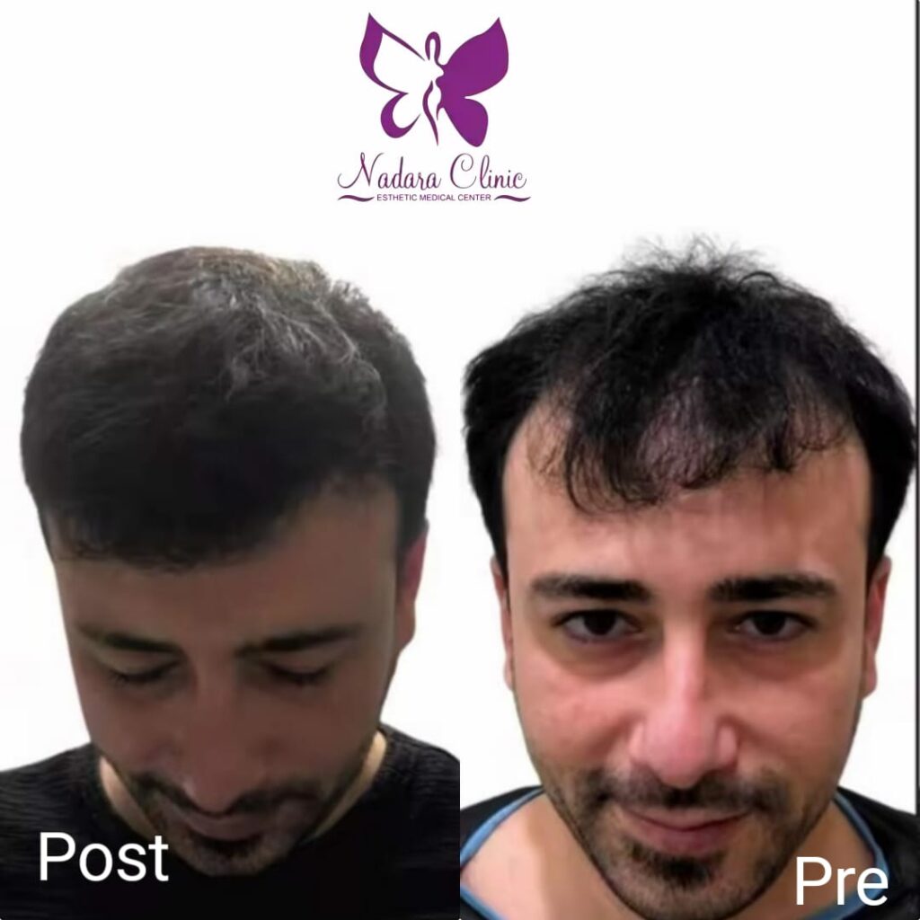 زراعة فراغات الشعر قبل وبعد