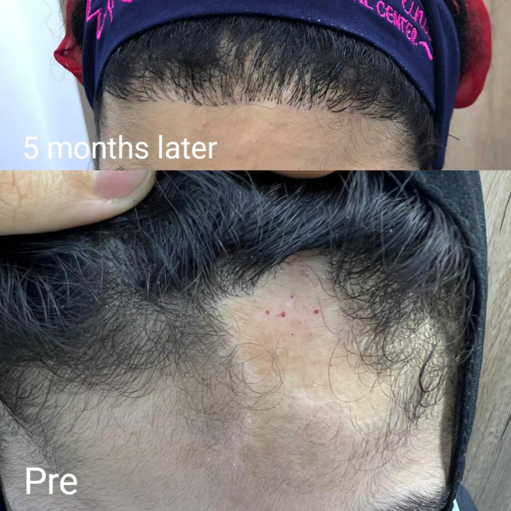 Hair transplantation for women before and after