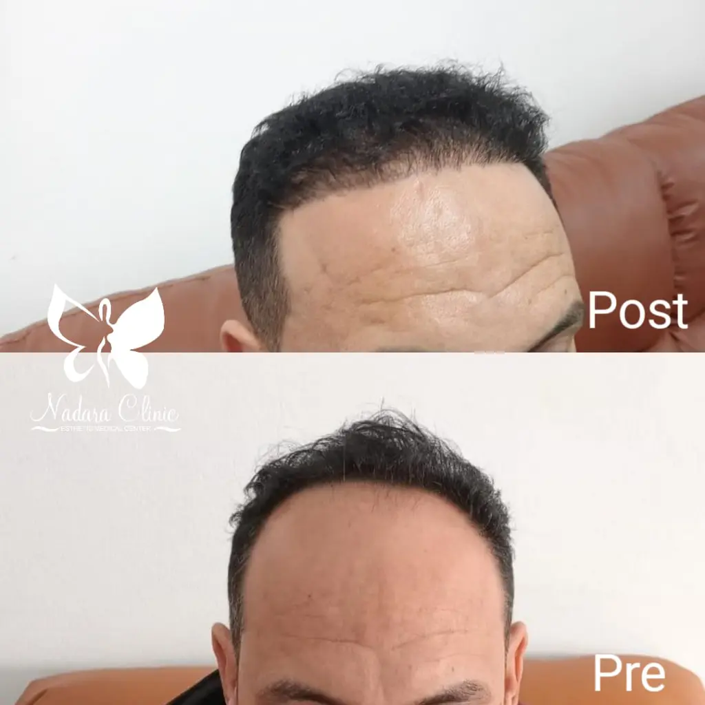 Hair transplantation