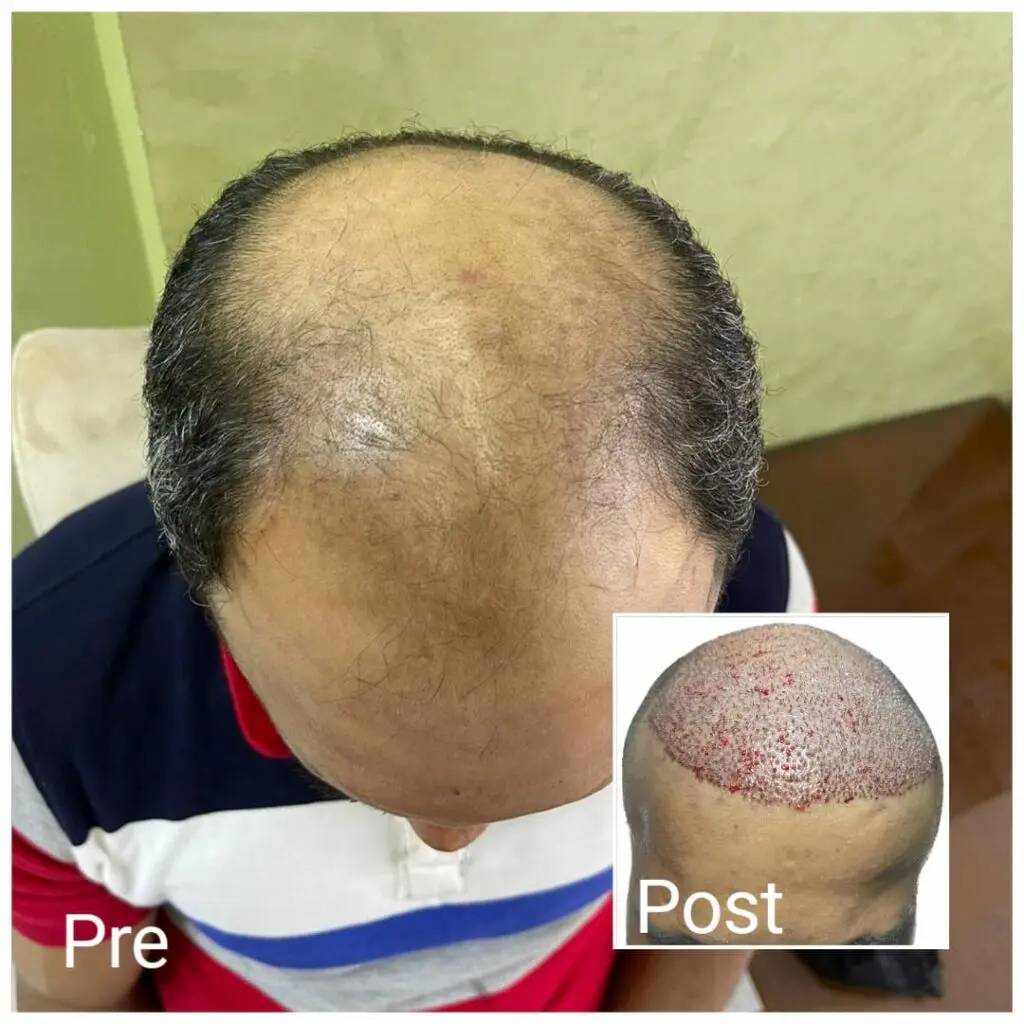 Results before and after hair transplantation for men in Egypt