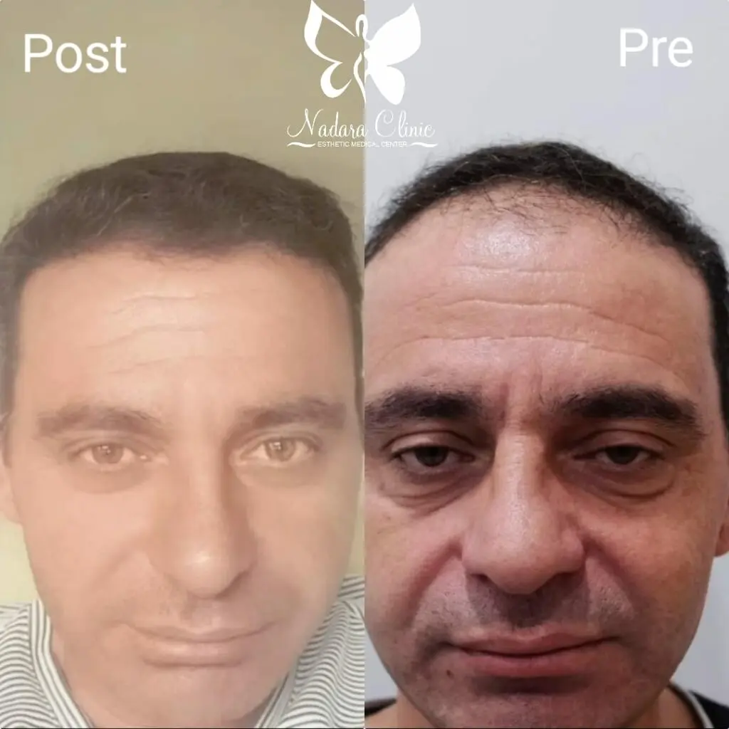 نتيجة زراعة الشعر في الغردقة