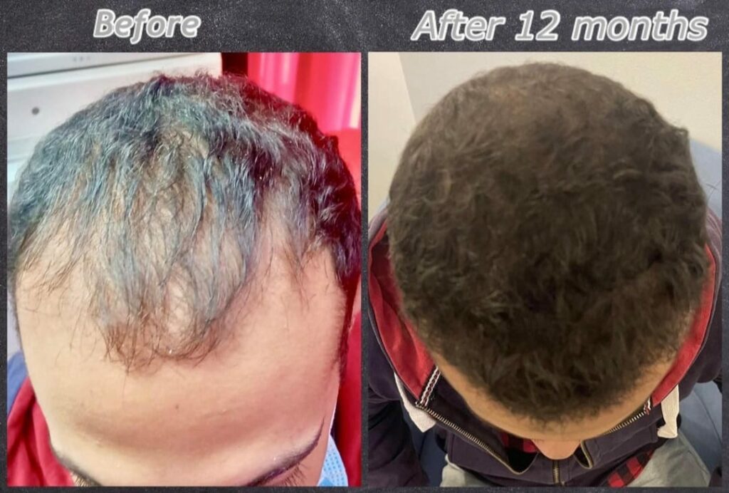Hair transplant results before and after