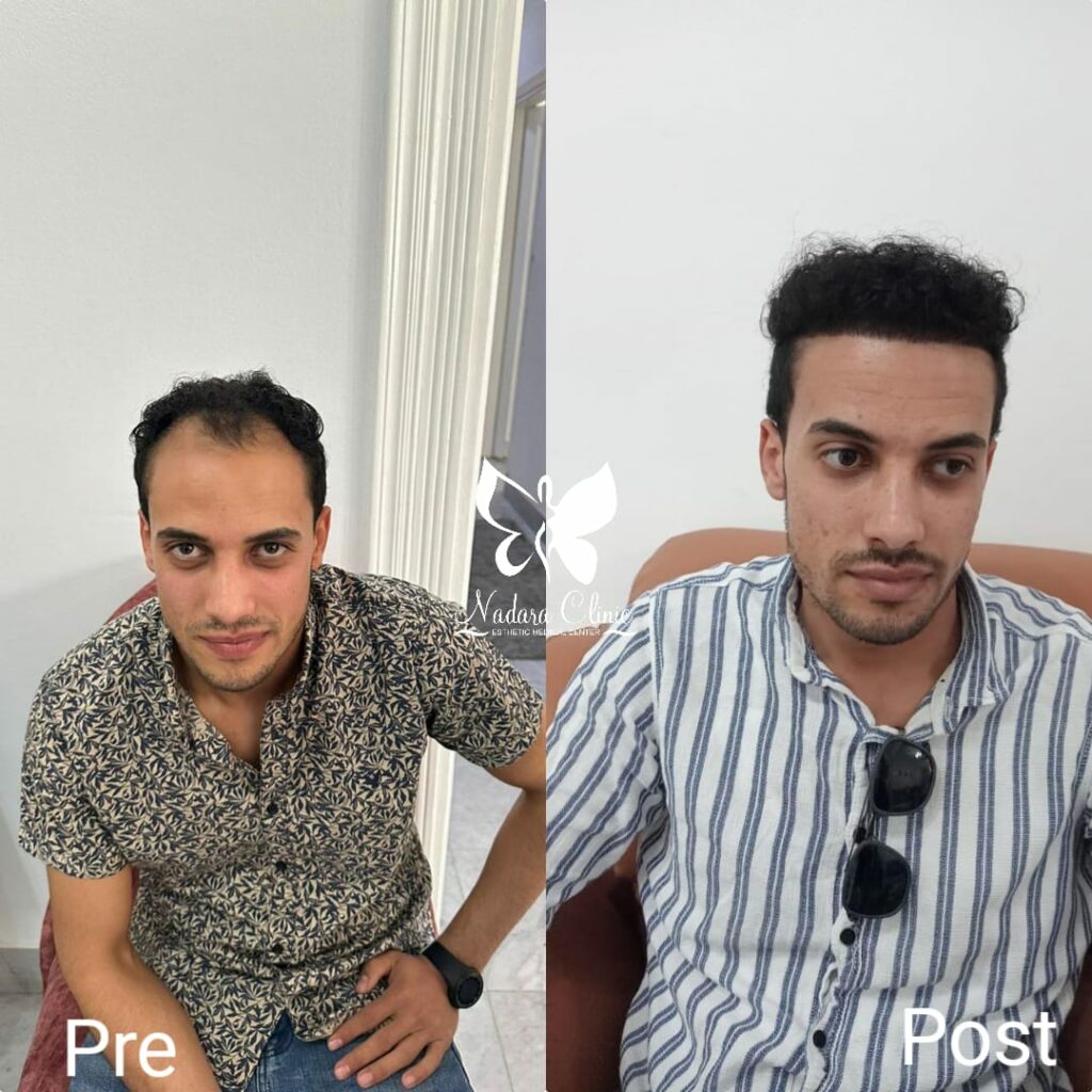 Hair transplant result