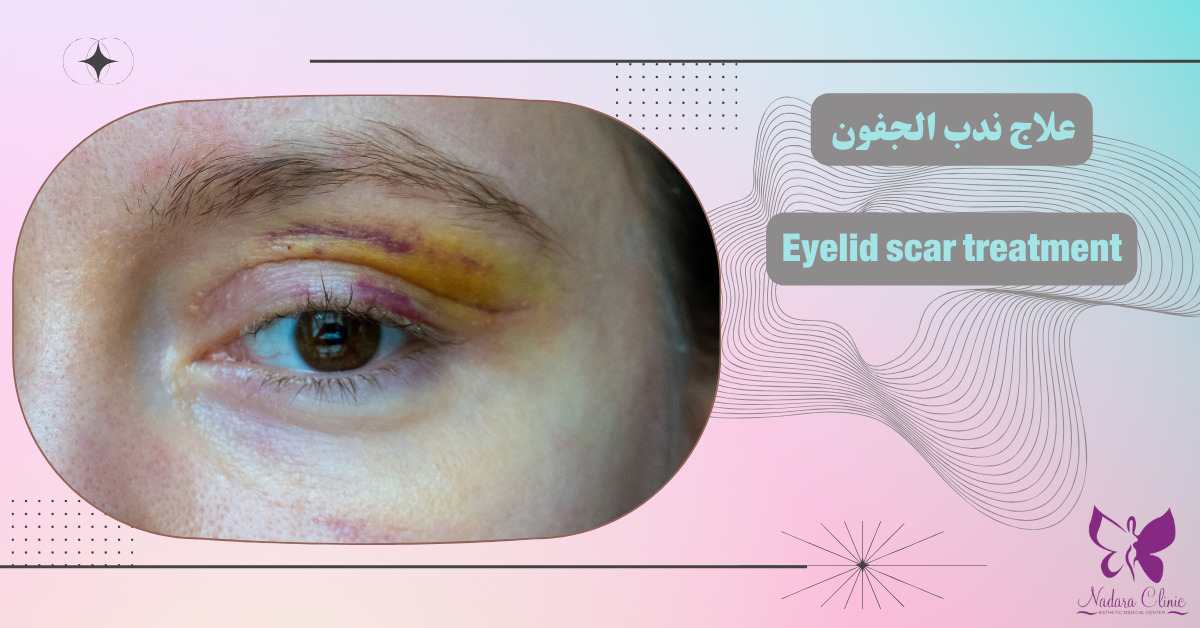 علاج ندب الجفون في الغردقة -احجز الآن-مركز نضارة