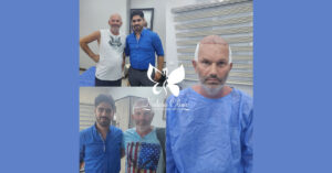 Hair transplant in Egypt