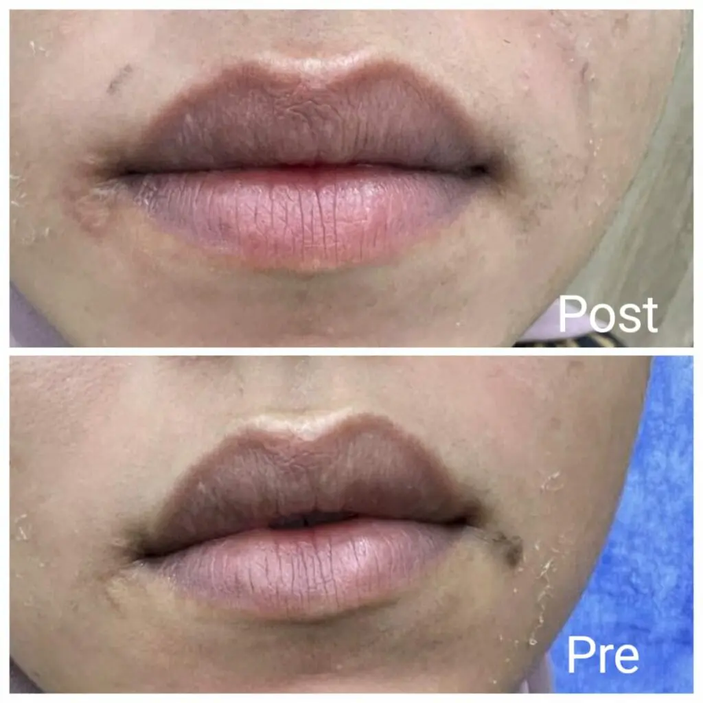 Removing lip tan with carbon laser