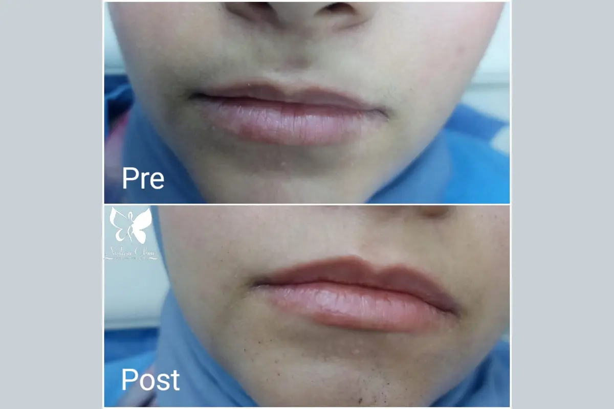 Pink lips with carbon laser in Hurghada | Book now | Nadara