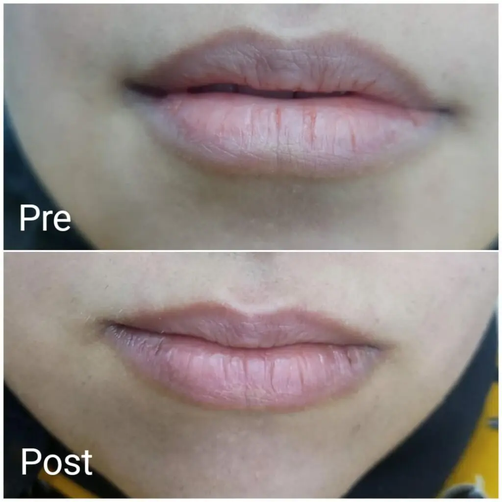 Lip plumping after one session