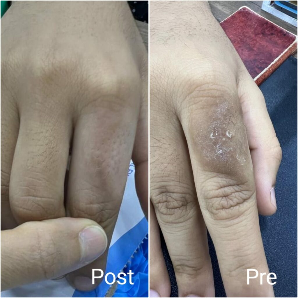 مركز جلدية في الغردقة علاج الجلد الميت والجلد الخشن
