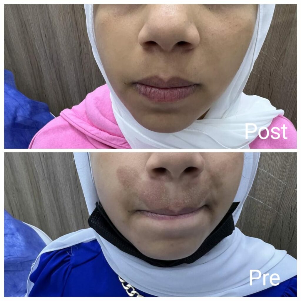 The result of removing pigmentation after one session