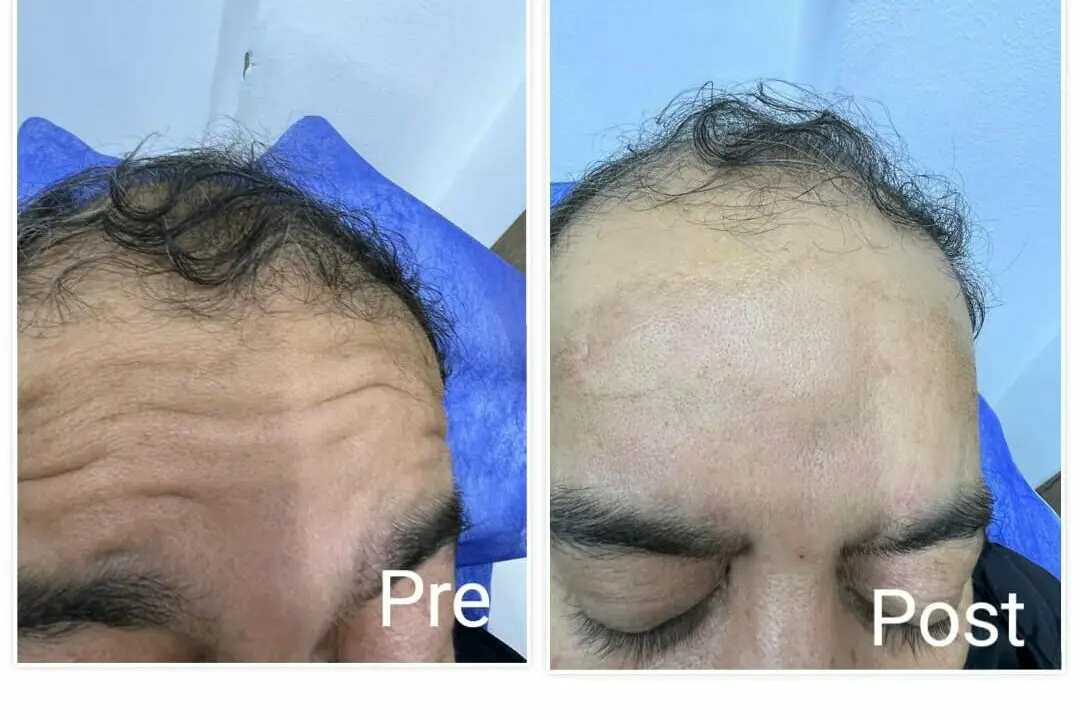 Removing wrinkles and lines on the forehead with Botox