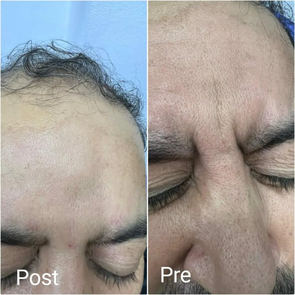 Removing signs of anger 111 and wrinkles between the eyebrows