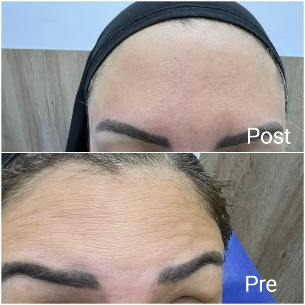 Forehead Botox to remove forehead wrinkles for women