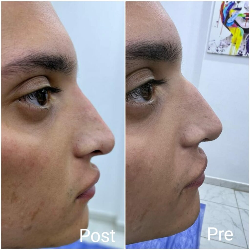 Rhinoplasty at the best filler clinic in Hurghada Rhinoplasty at the best filler clinic in Hurghada