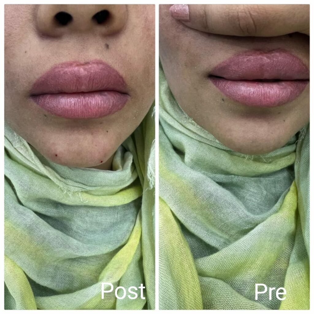Chin definition with filler