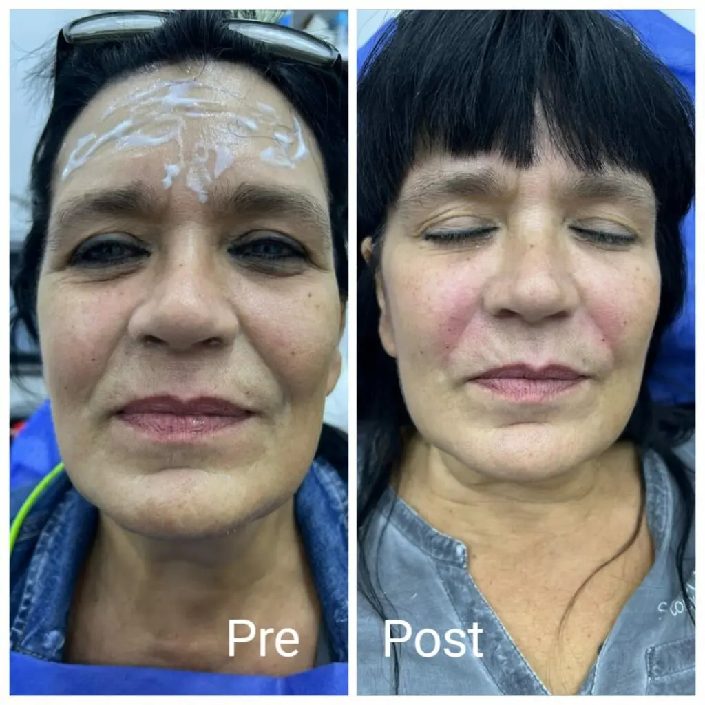 Filler injections into the cheeks and smile line