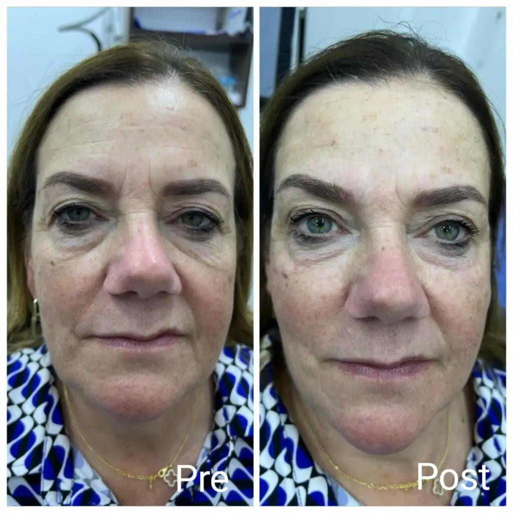 Injections of cheek filler and under-eye filler for wrinkles