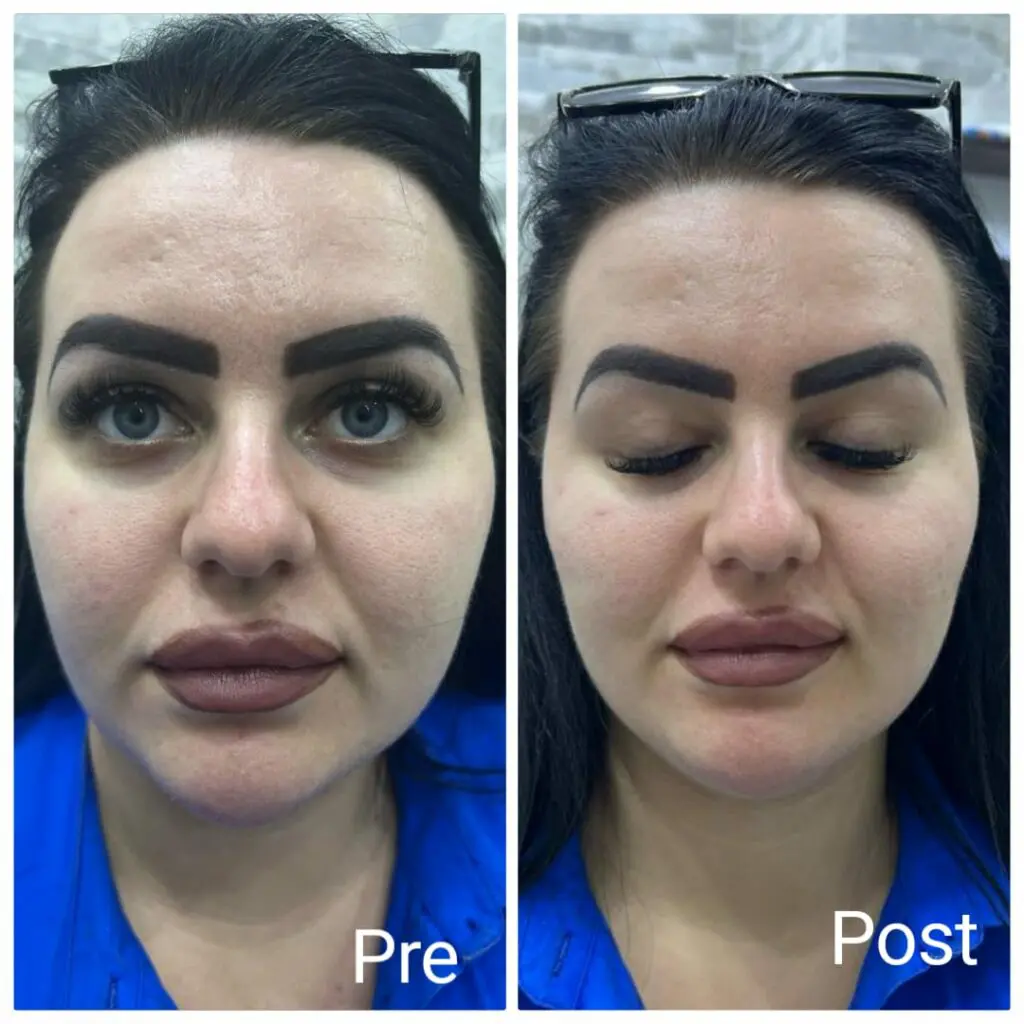 Contour the cheeks with filler