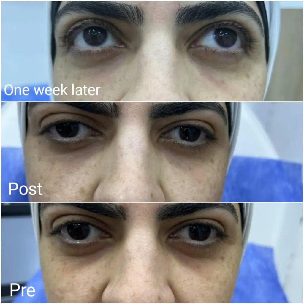 Results of improvement in dark circles after a week of under-eye filler