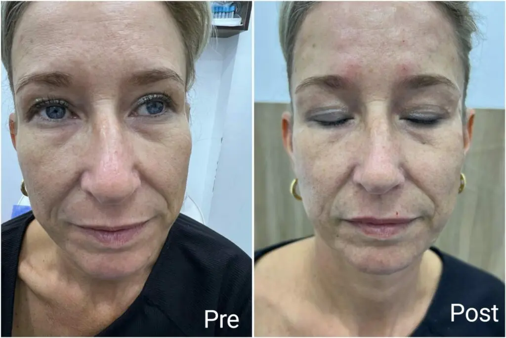 The results of injecting 1 ml of cheek filler before and after
