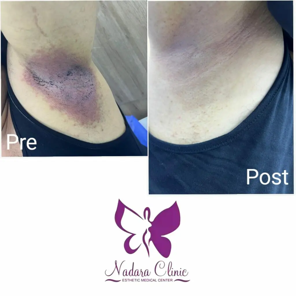 熱傷治療マニュアル = CURRENT TREATMENT FOR BURN … 熱傷治療マニュアル CURRENT TREATMENT FOR BURN Burns