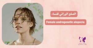 Female androgenetic alopecia in hurghada