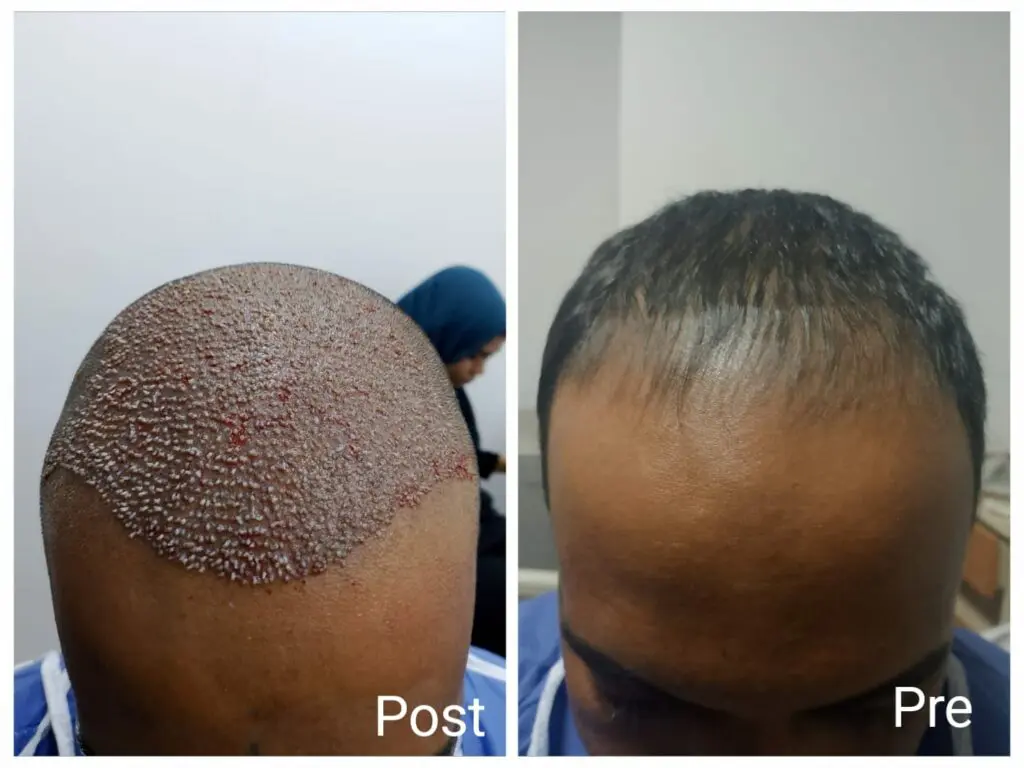 زراعة الشعر بالريجينيرا قبل وبعد