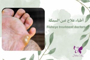 Fisheye treatment doctors in Hurghada