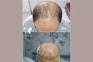 Regenera hair transplant in Hurghada