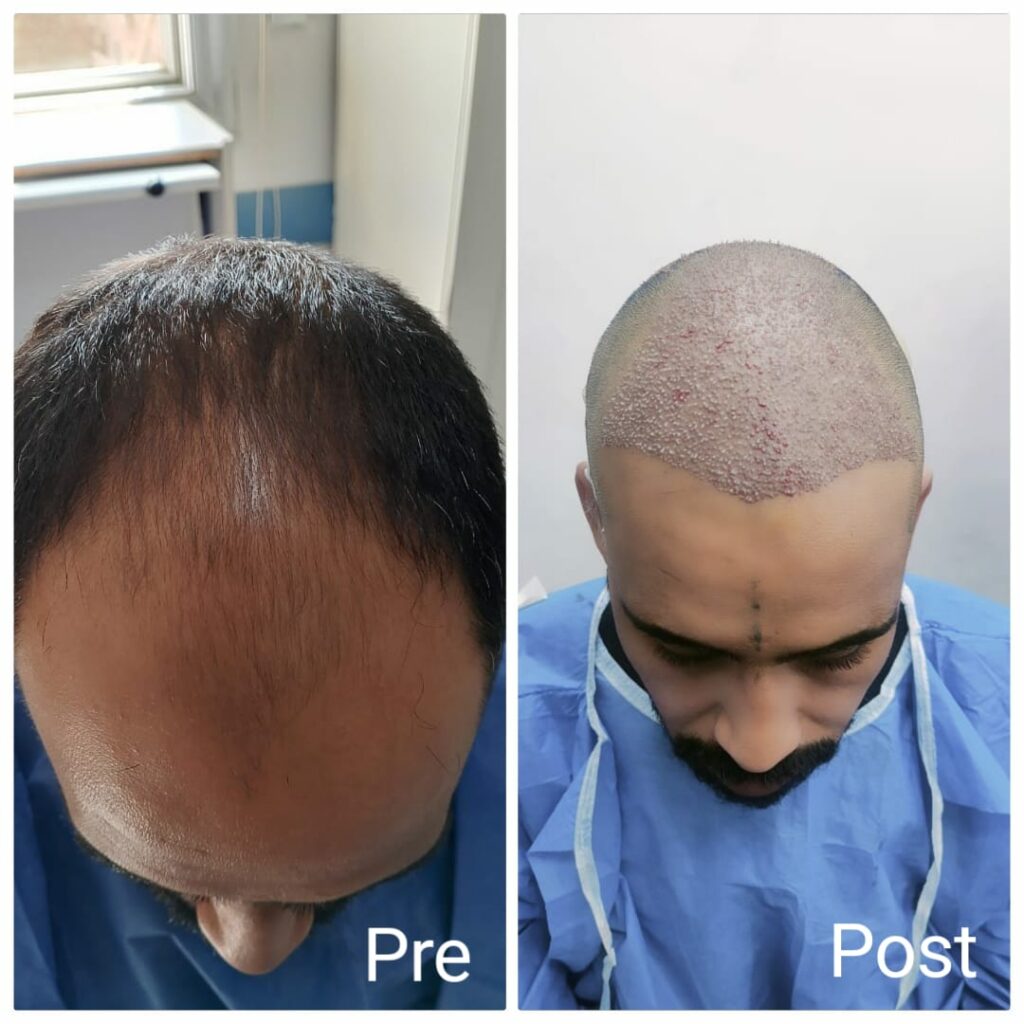 Results of the Regenera hair transplant technique