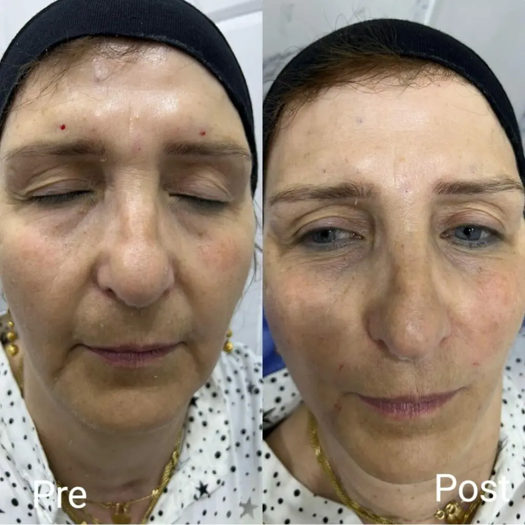 Removing smile lines before and after