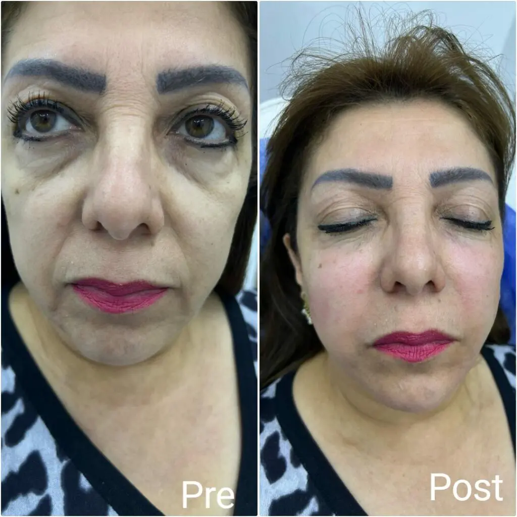 Results of plasma filler for the face before and after