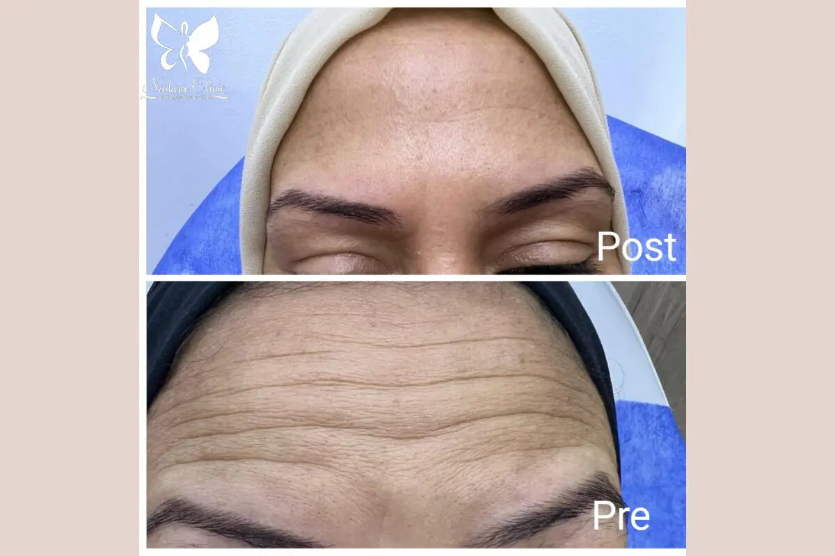 Botox for facial wrinkles in Hurghada