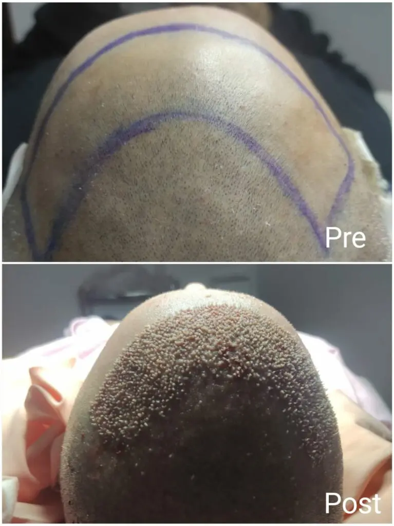 Hair transplantation using Regenera technique before and after