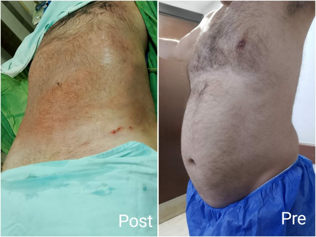 Liposuction in Egypt before and after