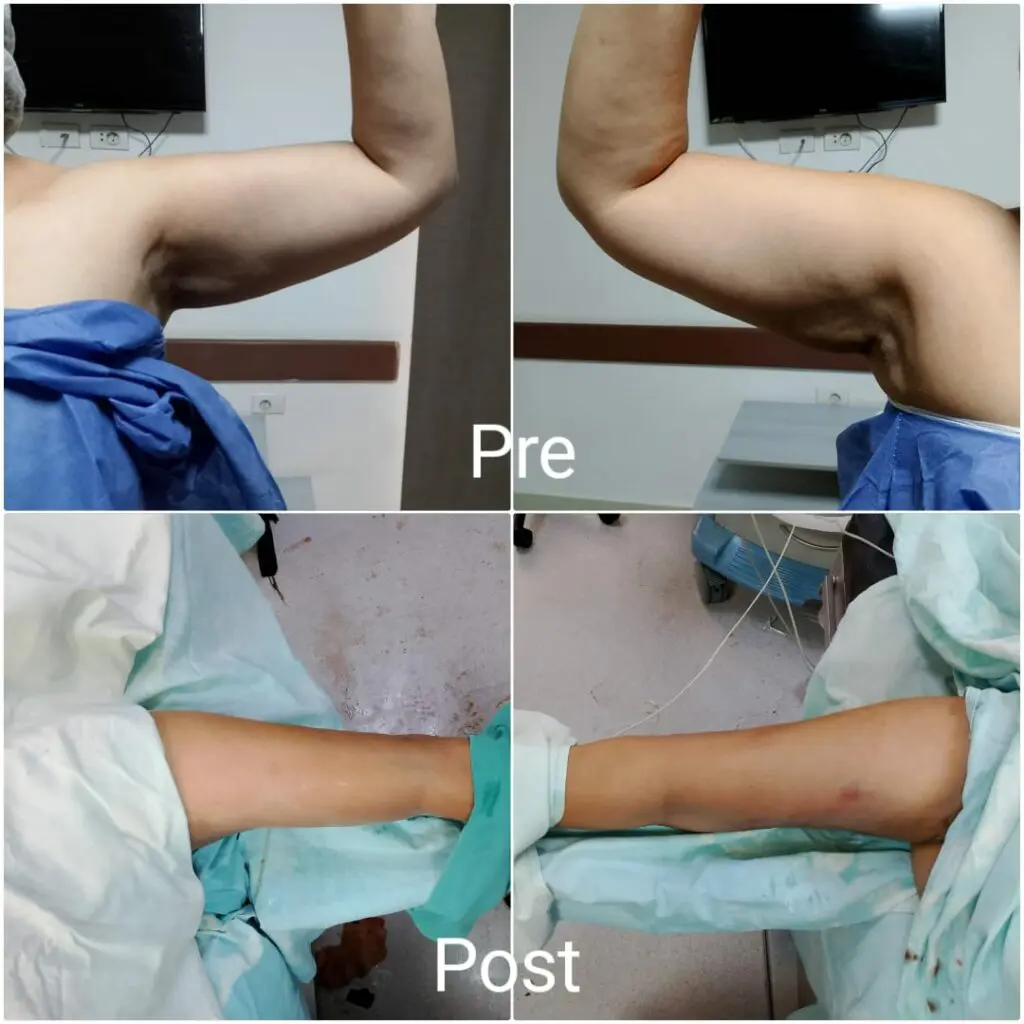 Arm liposuction before and after