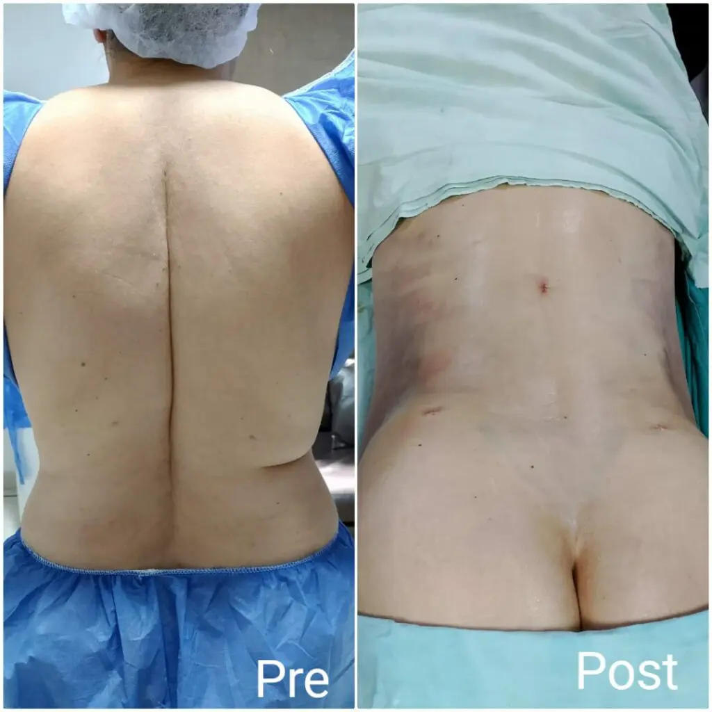 Back liposuction in Egypt