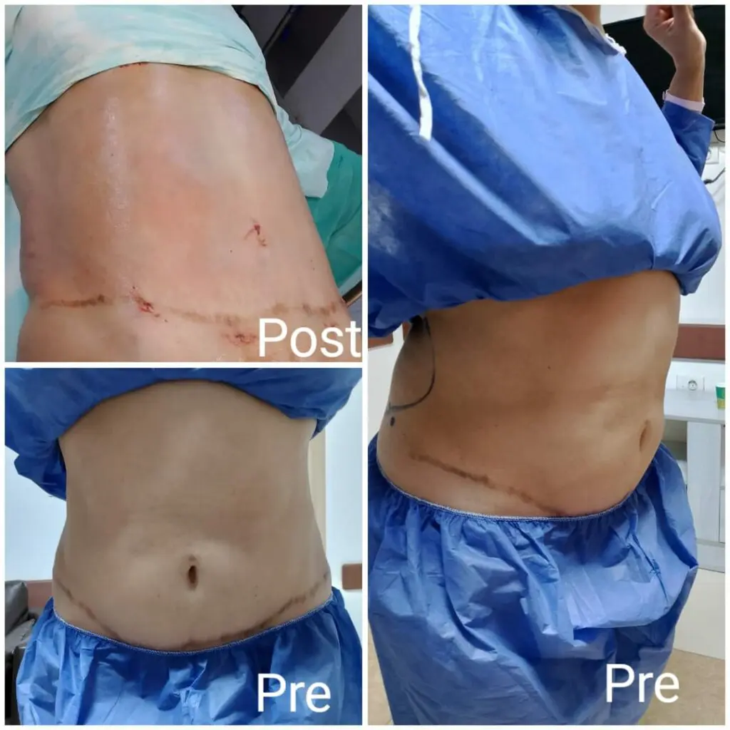 Tummy tuck and liposuction before and after