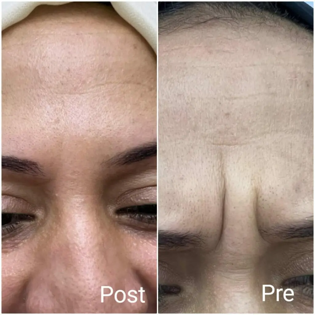 Treating forehead wrinkles with Botox