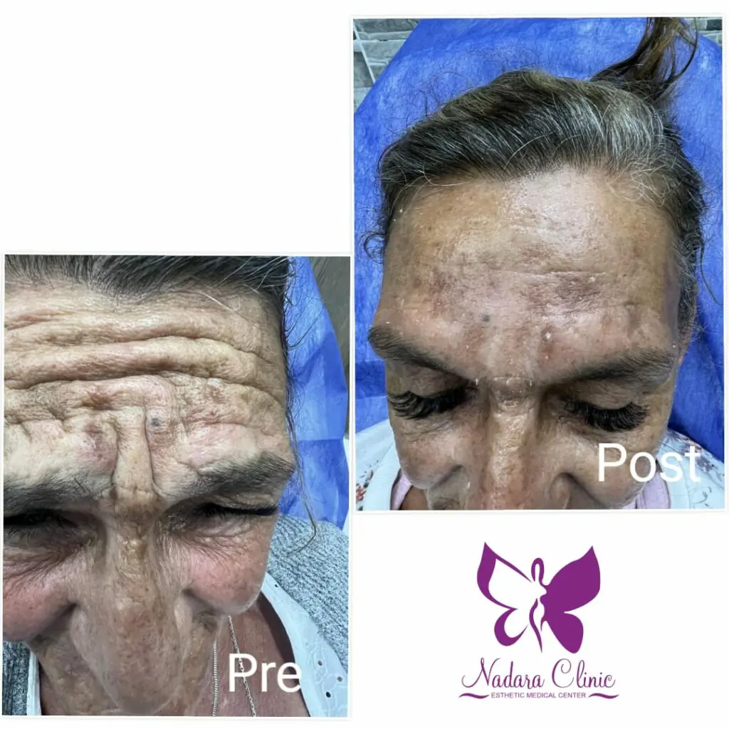 Treatment of forehead wrinkles before and after