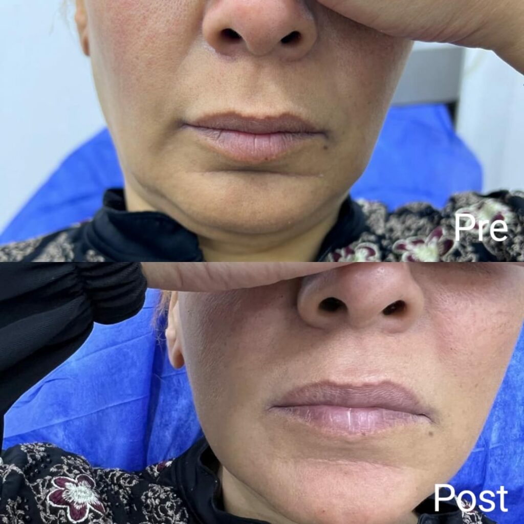Treating smile lines before and after