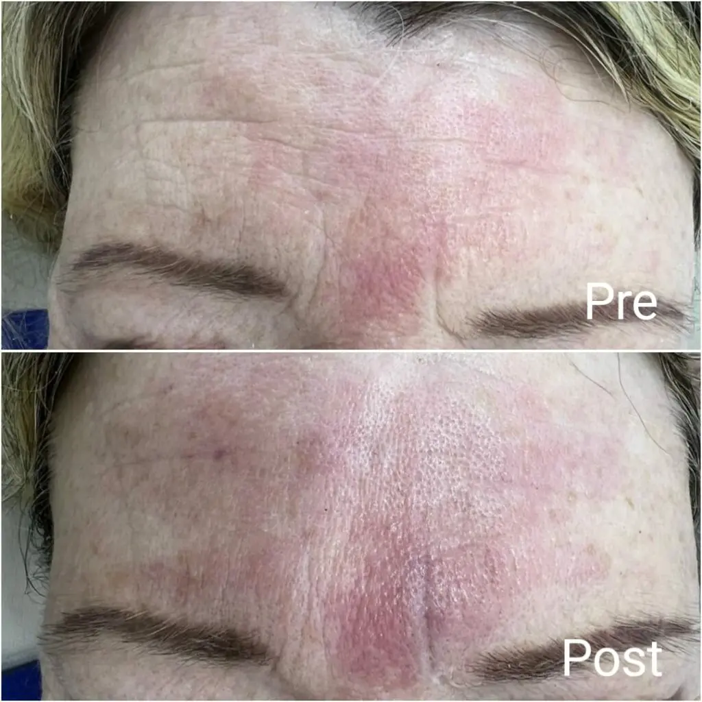 Forehead filler to treat wrinkle lines