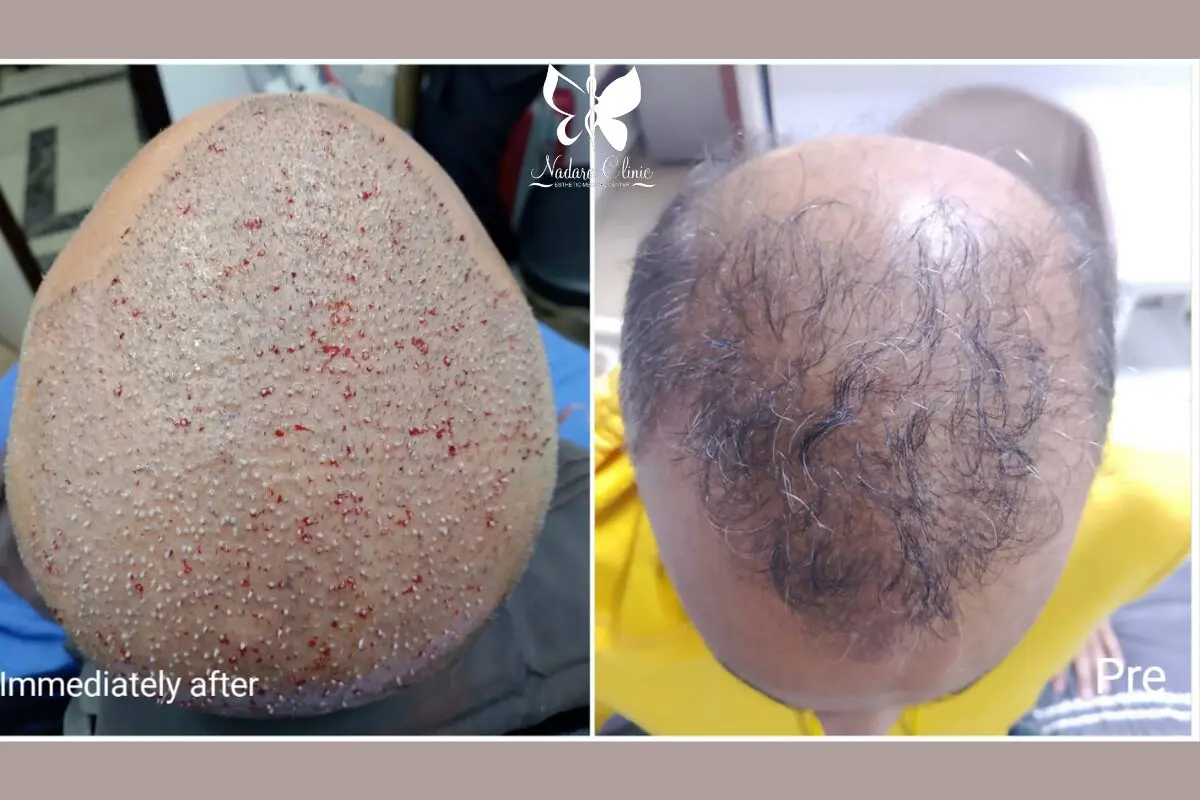 Regenera hair transplant in Egypt